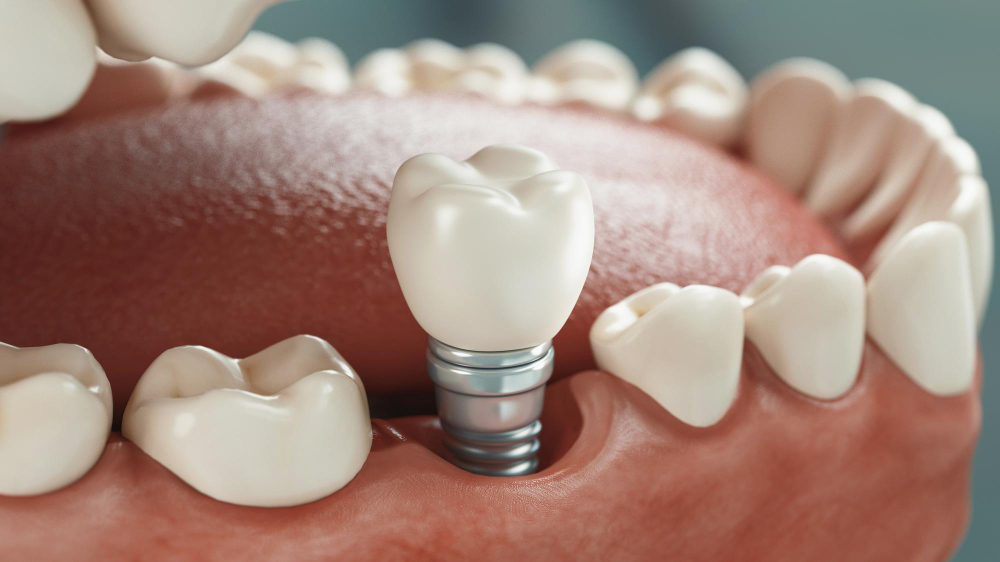 Dental Implants in Little Elm